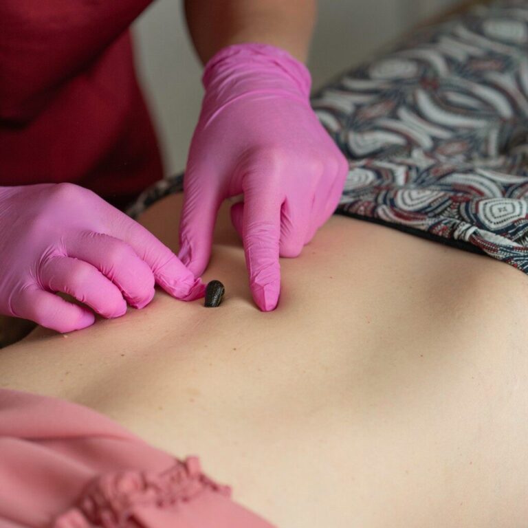 Domowa hirudoterapia
